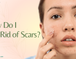 How Do I Get Rid of Scars