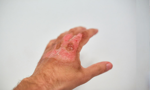 How Do I Get Rid of Scars-Contracture scars