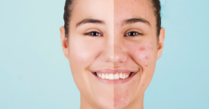 Most Asked Question About Acne