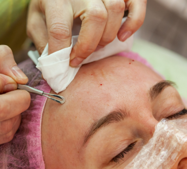 Why Holistic Acne Treatment is Better Than Modern Acne Treatment