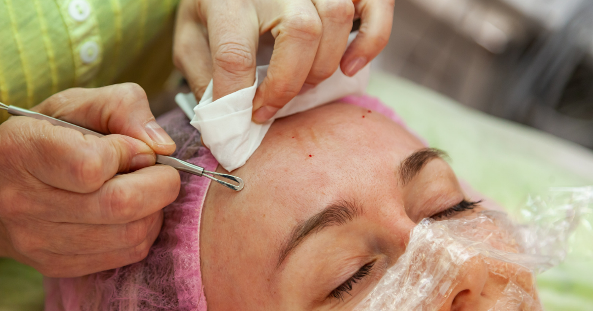 Why Holistic Acne Treatment is Better Than Modern Acne Treatment