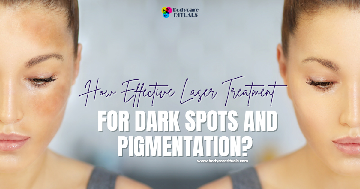 How Effective Laser Treatment for Dark Spots and Pigmentation